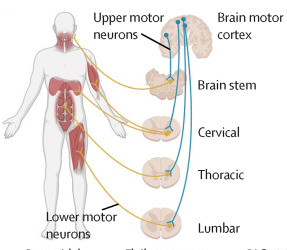 Figure 1 A from Dr. Eva Feldman's ALS seminar in The Lancet that shows a schematic of upper and lower motor neurons