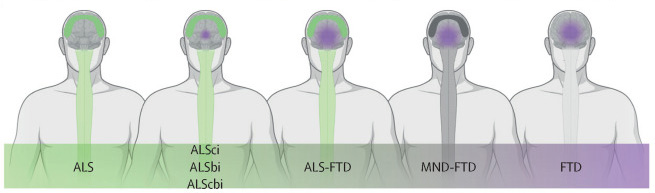 Figure 1 C from Dr. Eva Feldman's ALS seminar in The Lancet that shows onsets of ALS