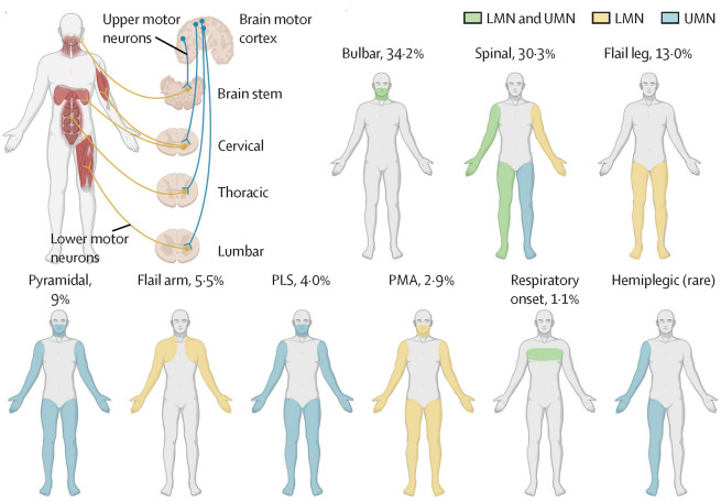 Figure 1 A and B from Dr. Eva Feldman's ALS seminar in The Lancet that shows onsets of ALS