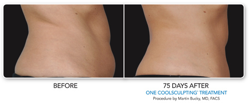 CDLC CoolSculpting Before and After