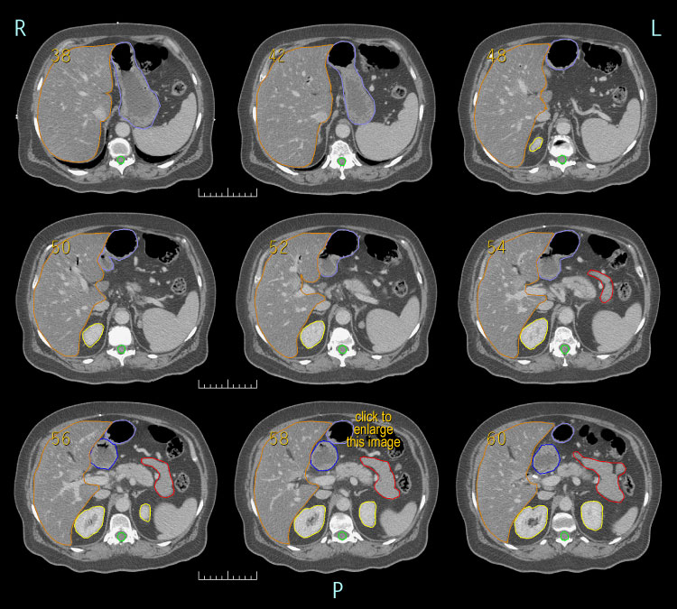 IMRT for unresectable pancreatic cancer- case 1A