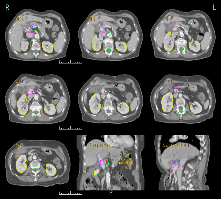 3D post-op RT for pancreatic cancer, case 3B