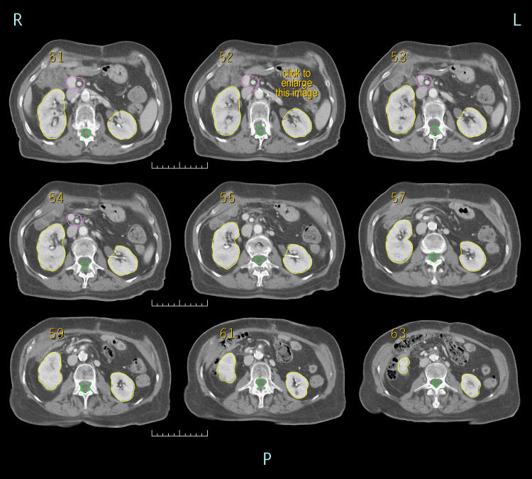 3D post-op RT for pancreatic cancer, case 3C