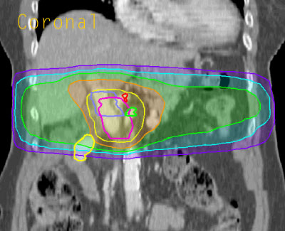 Dose distribution case 3, coronal view section