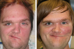 Brandon Haag, before and after treatment