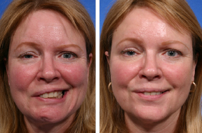 Ann Mayo, before and after treatment
