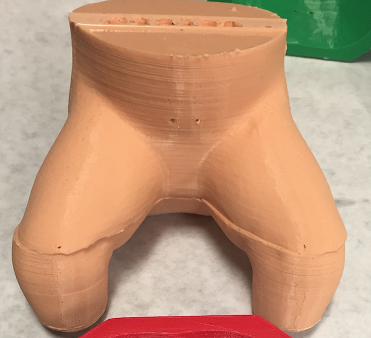 3D Printed Baby Hip
