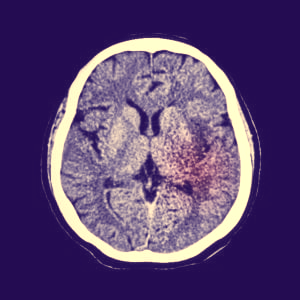 Brain with stroke
