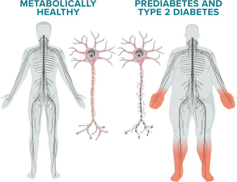 Figure 2 from the Pathophysiology of DPN written by Dr. Eva Feldman from the ADA's 2022 Compendium on diabetic peripheral neuropathy