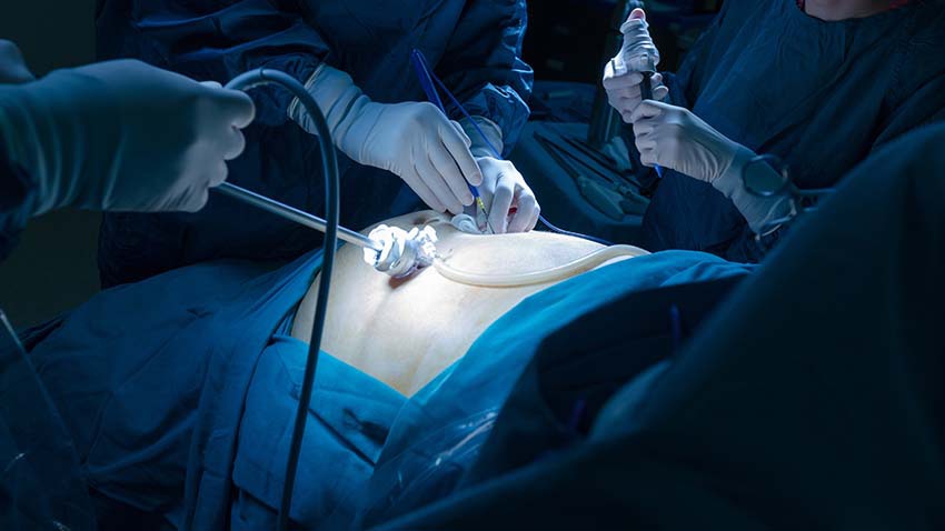 Surgery to remove appendix