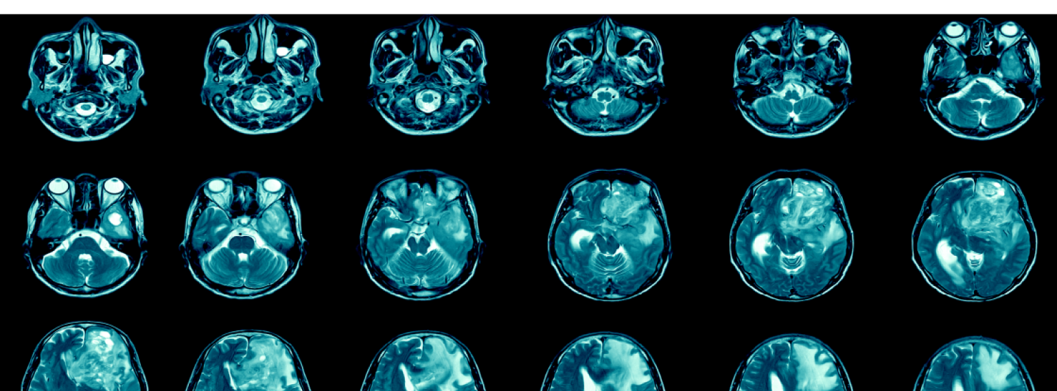 An image of various brain scans with text overlay