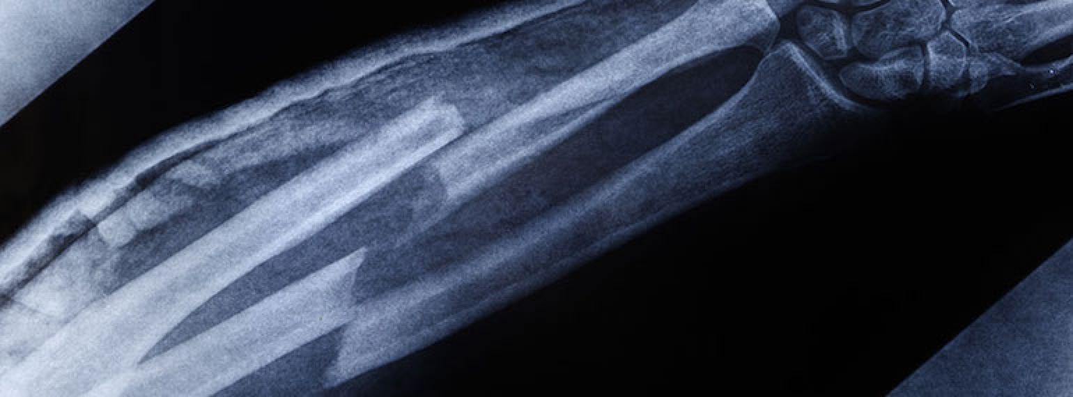 X ray of a broken arm