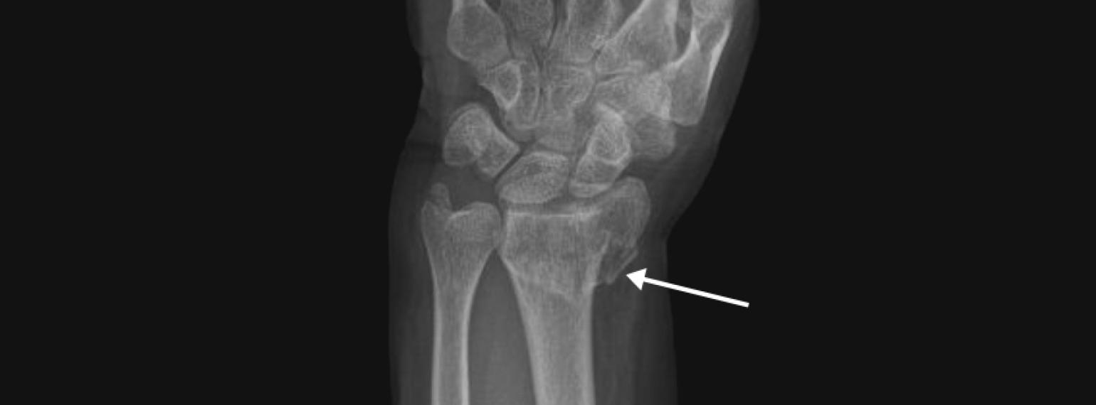 X-ray of a wrist bone fracture