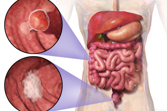photo of colorectal cancer
