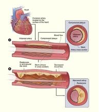 Coronary Angioplasty and Stenting | University of Michigan, Ann Arbor