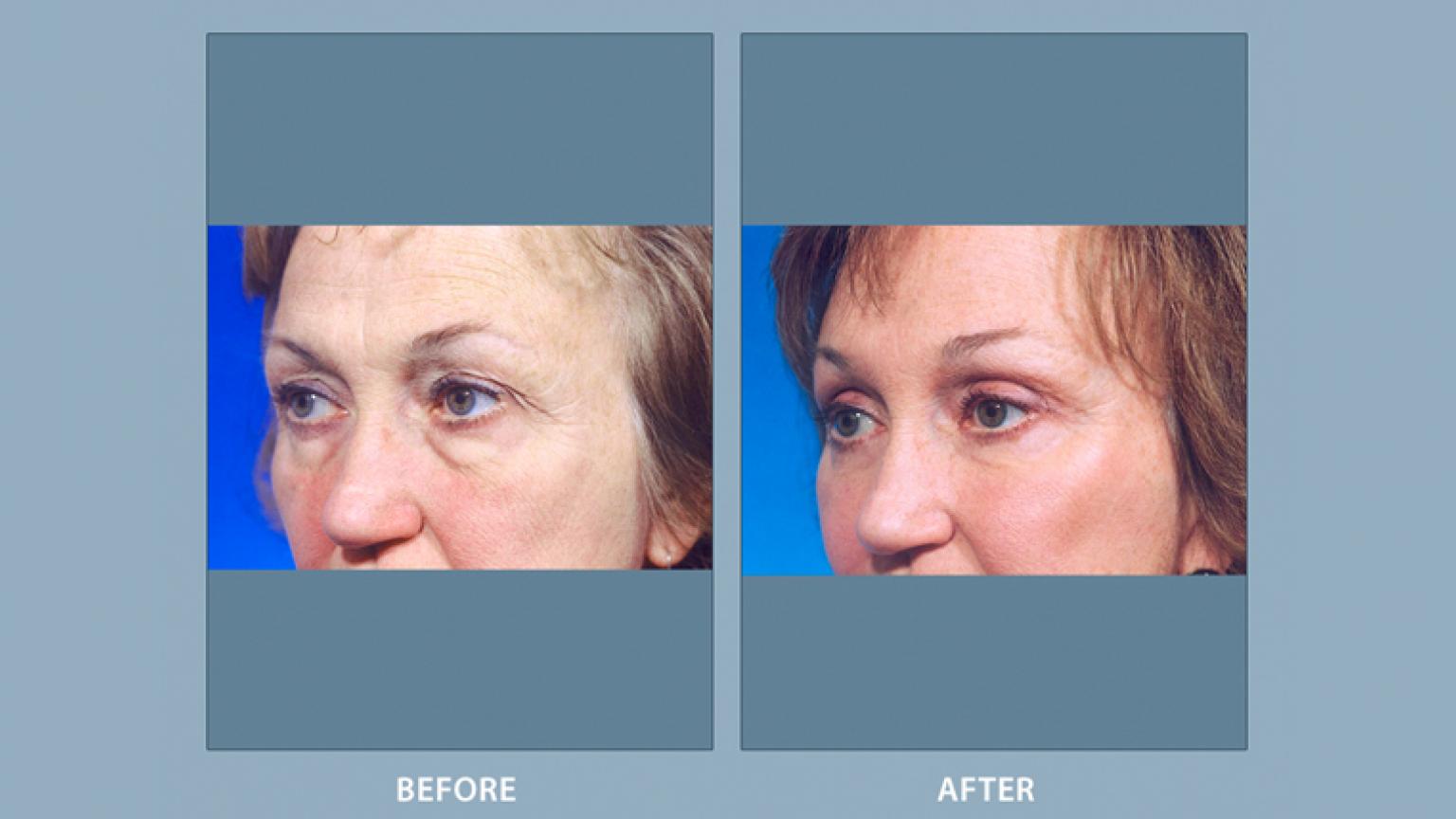 Facelift, Facial Cosmetic Surgery, Michigan Medicine
