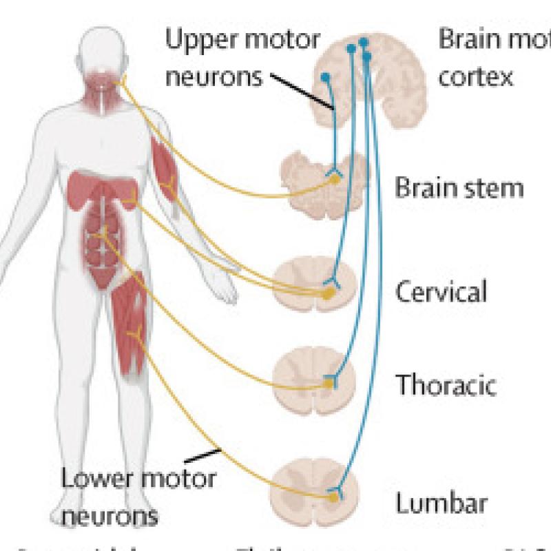 Figure 1 A from Dr. Eva Feldman's ALS seminar in The Lancet that shows a schematic of upper and lower motor neurons