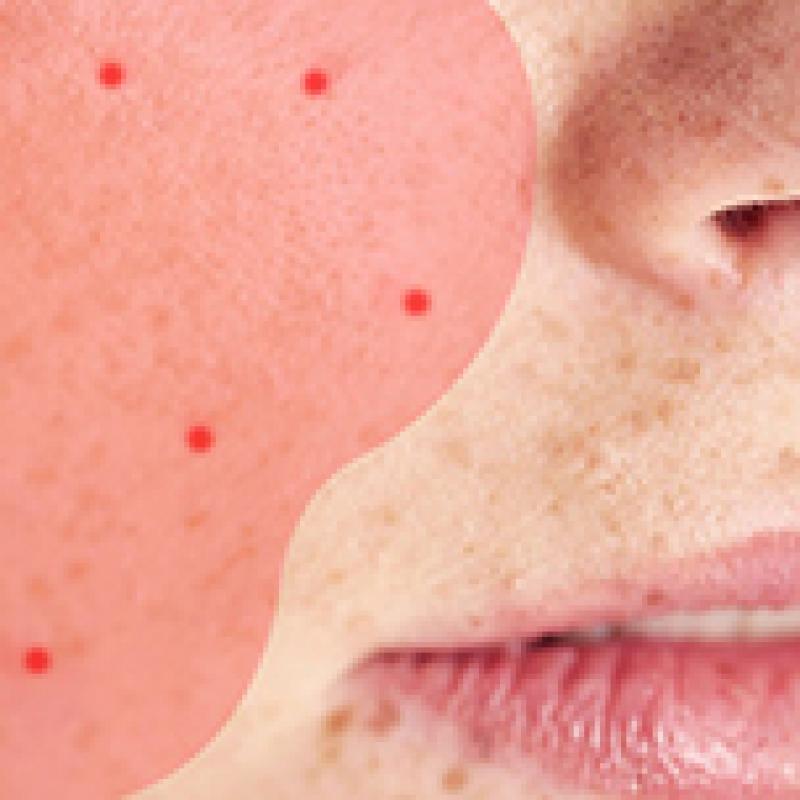 How to Tell if Your 'Acne' Might Actually Be Rosacea