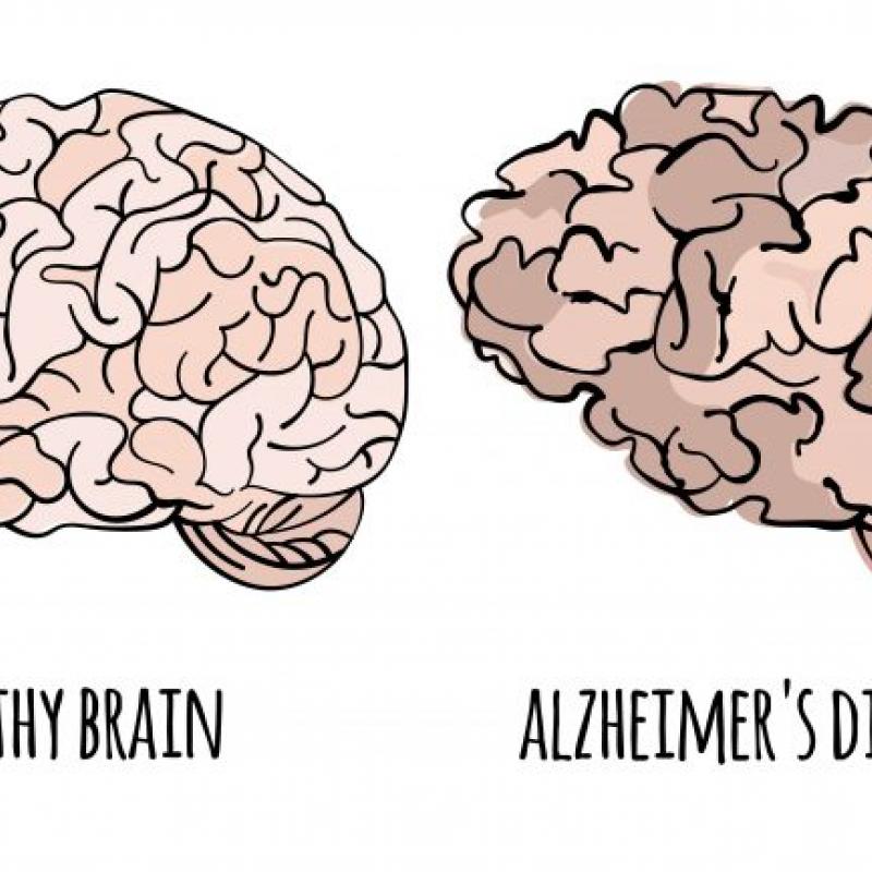 Alzheimer's Disease Brain Graphic